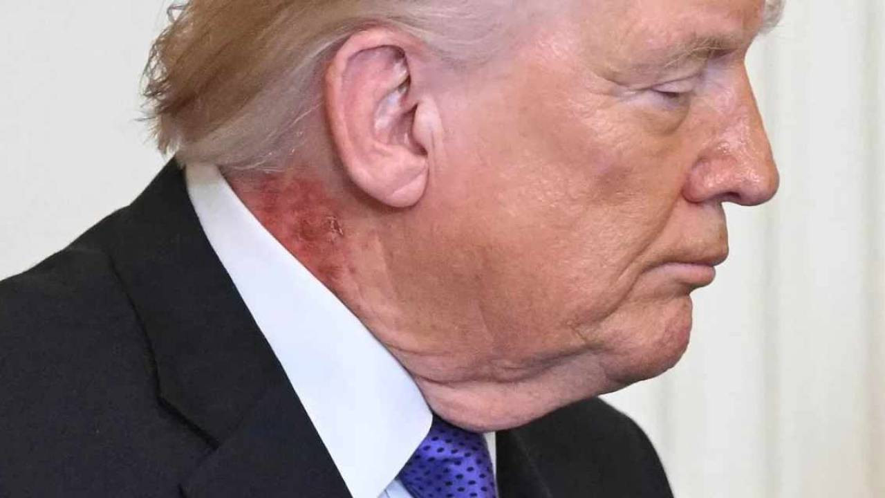 Trump’ın boynundaki yara gündem oldu