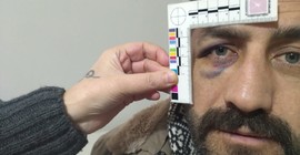 Van'da polis şiddeti: Görme kaybı yaşıyor