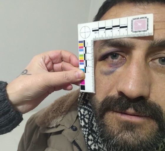 Van'da polis şiddeti: Görme kaybı yaşıyor