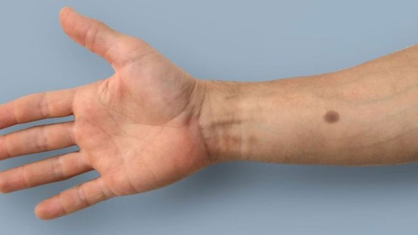Kanseri başlangıcında tespit edebilecek deri implantı geliştirildi - Resim : 1