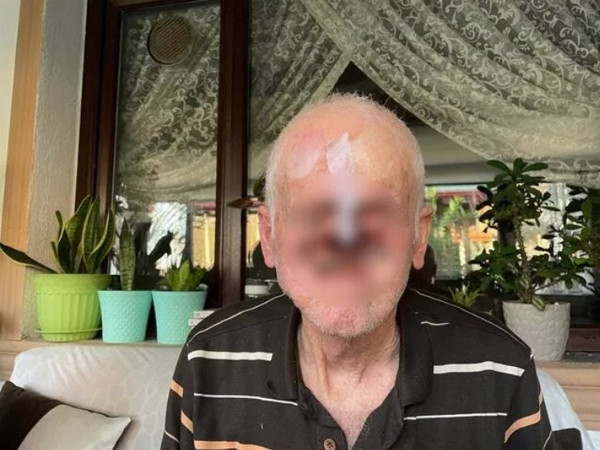 Bir sivilce ile hayatı kabusa döndü: Burnunu tamamen kaybetti - Resim : 1