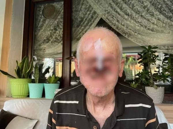Bir sivilce ile hayatı kabusa döndü: Burnunu tamamen kaybetti - Resim : 1