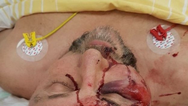 Almanya'da aşırı sağcı milletvekili saldırı sonucu ağır yaralandı - Resim : 1