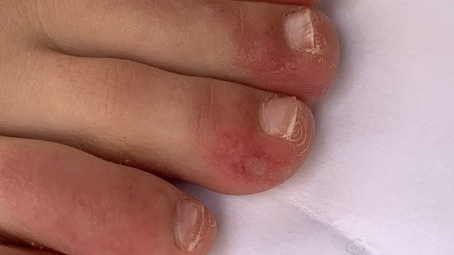 Korona hastalarında hangi cilt döküntülerine rastlanıyor? - Resim : 2