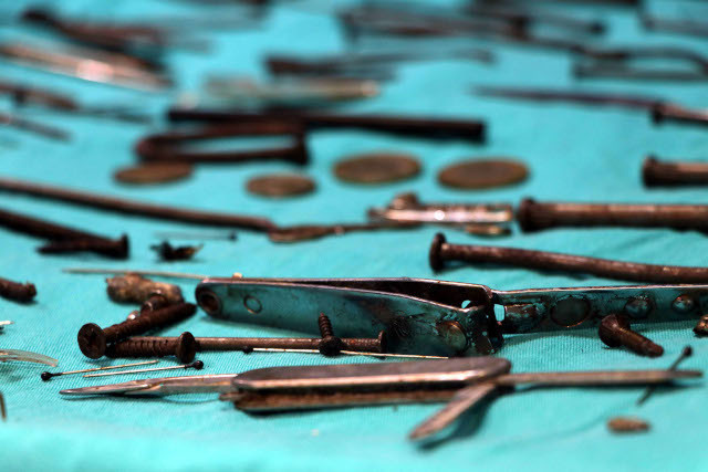 Midesinden 158 parça metal çıkarıldı - Resim : 1