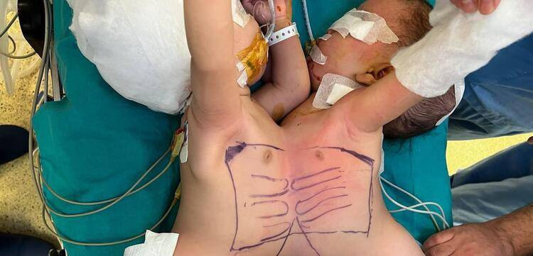 Birbirlerinden ayrılan siyam ikizleri iyileşti, taburcu oluyor - Resim: 2