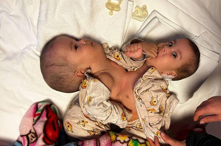 Birbirlerinden ayrılan siyam ikizleri iyileşti, taburcu oluyor - Resim: 1
