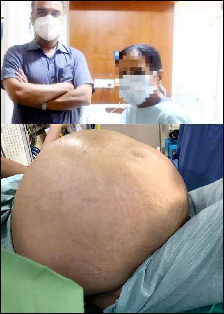 Hindistan'da bir kadının yumurtalığından 54 kilogram tümör çıkarıldı - Resim : 1