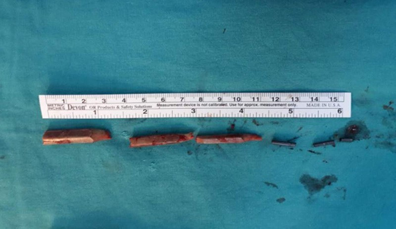 15 ay kalçasında 10 cm'lik kurşun kalem ile yaşadı - Resim : 1