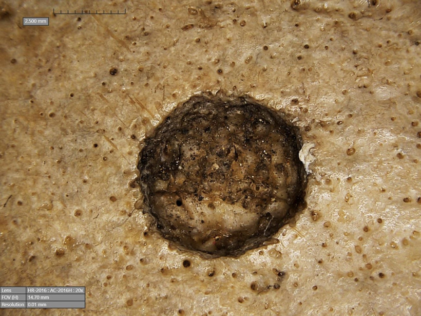 ancient-skull-cancer-2-kdow.jpg